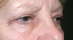 Eyelid Surgery