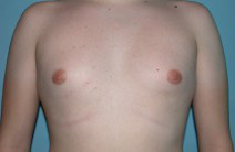 Gynecomastia - Male Breast Reduction