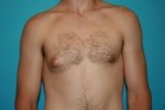 Gynecomastia - Male Breast Reduction