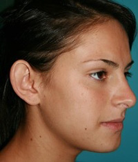 Ear Reshaping - Otoplasy