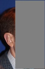 Ear Reshaping - Otoplasty
