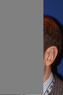 Ear Reshaping - Otoplasy