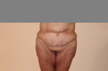Body Contouring After Major Weight Loss