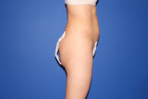 Liposuction Results Boston
