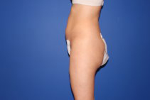 Liposuction Results Boston