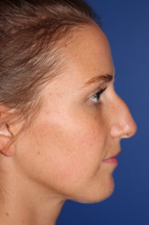 Rhinoplasty - Nasal Reshaping