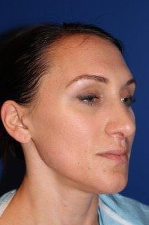 Rhinoplasty - Nasal Reshaping